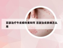 百部治疗牛皮癣效果如何 百部治皮肤病怎么用