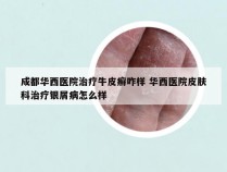 成都华西医院治疗牛皮癣咋样 华西医院皮肤科治疗银屑病怎么样