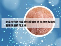 北京协和医院皮肤科看银屑病 北京协和医院看银屑病费用怎样