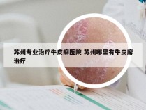 苏州专业治疗牛皮癣医院 苏州哪里有牛皮廨治疗