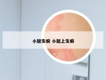 小腿生癣 小腿上生癣