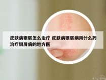 皮肤病银屑怎么治疗 皮肤病银屑病用什么药治疗银屑病的地方医