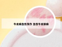 牛皮癣急性发作 急性牛皮肤癣