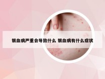 银血病严重会导致什么 银血病有什么症状