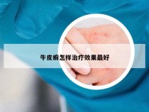 牛皮癣怎样治疗效果最好