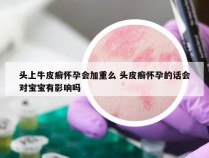 头上牛皮癣怀孕会加重么 头皮癣怀孕的话会对宝宝有影响吗