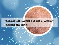 冶疗头癣的特效中药处方单子图片 中药治疗头癣的外用方剂药方