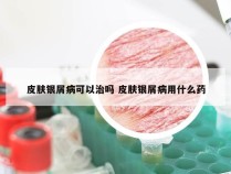 皮肤银屑病可以治吗 皮肤银屑病用什么药