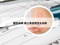 腿伤白斑 腿上有白斑怎么去除