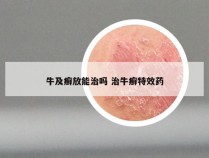 牛及癣放能治吗 治牛癣特效药