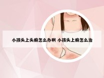 小孩头上头癣怎么办啊 小孩头上癣怎么治