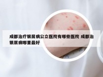 成都治疗银屑病公立医院有哪些医院 成都治银屑病哪里最好