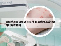 银屑病用二硫化硒可以吗 银屑病用二硫化硒可以吗有用吗