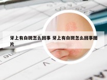 牙上有白斑怎么回事 牙上有白斑怎么回事图片