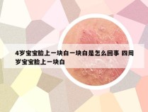 4岁宝宝脸上一块白一块白是怎么回事 四周岁宝宝脸上一块白