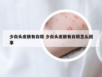 少白头皮肤有白斑 少白头皮肤有白斑怎么回事