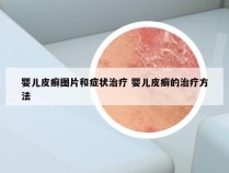 婴儿皮癣图片和症状治疗 婴儿皮癣的治疗方法