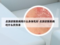 点滴状银屑病用什么身体乳好 点滴状银屑病吃什么抗生素