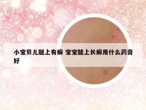 小宝贝儿腿上有癣 宝宝腿上长癣用什么药膏好