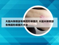 大腿内侧根部有椭圆形癣图片 大腿内侧根部有椭圆形癣图片大全