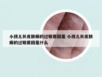 小孩儿长皮肤癣的过敏原因是 小孩儿长皮肤癣的过敏原因是什么