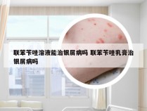 联苯苄唑溶液能治银屑病吗 联苯苄唑乳膏治银屑病吗