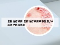 怎样治疗银屑 怎样治疗银屑病不复发,30年老中医告诉你