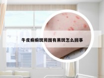 牛皮癣癣斑周围有黑斑怎么回事