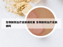 生物制剂治疗皮肤病效果 生物制剂治疗皮肤病吗