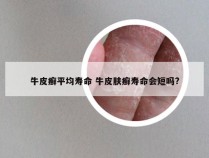 牛皮癣平均寿命 牛皮肤癣寿命会短吗?