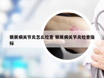 银屑病关节炎怎么检查 银屑病关节炎检查指标