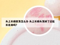 头上长癣脱发怎么办 头上长癣头发掉了还能长出来吗?