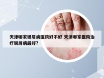 天津哪家银屑病医院好不好 天津哪家医院治疗银屑病最好?