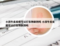 小孩牛皮皮癣可以打生物制剂吗 小孩牛皮皮癣可以打生物制剂吗