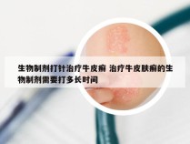 生物制剂打针治疗牛皮癣 治疗牛皮肤癣的生物制剂需要打多长时间