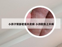 小孩子臀部老是长皮癣 小孩屁股上长癣