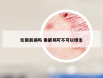 能银屑病吗 银屑病可不可以根治