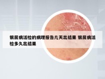 银屑病活检的病理报告几天出结果 银屑病活检多久出结果