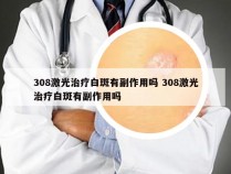 308激光治疗白斑有副作用吗 308激光治疗白斑有副作用吗