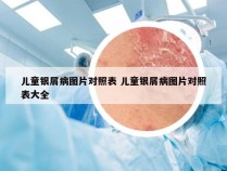 儿童银屑病图片对照表 儿童银屑病图片对照表大全