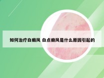 如何治疗白癜风 白点癫风是什么原因引起的