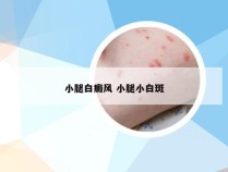 小腿白癜风 小腿小白斑