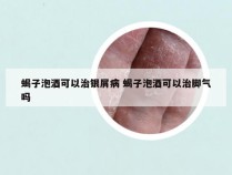 蝎子泡酒可以治银屑病 蝎子泡酒可以治脚气吗