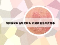 白鲜皮可以治牛皮癣么 白鲜皮能治牛皮屑不