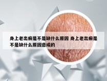 身上老出癣是不是缺什么原因 身上老出癣是不是缺什么原因造成的