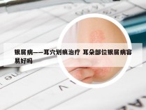 银屑病——耳穴划痕治疗 耳朵部位银屑病容易好吗