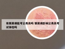 有银屑病能考公务员吗 银屑病影响公务员考试体检吗