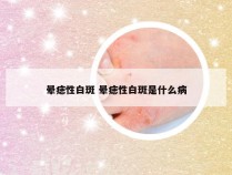 晕痣性白斑 晕痣性白斑是什么病