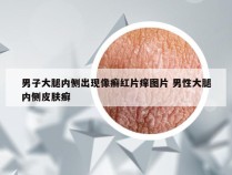 男子大腿内侧出现像癣红片痒图片 男性大腿内侧皮肤癣