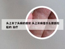 头上长了头癣的症状 头上长癣是什么原因引起的 治疗